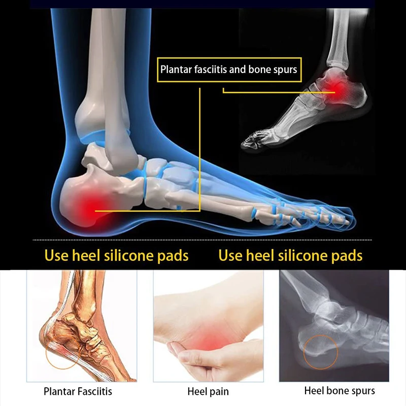 Pain Bone Spurs Heal Heel Bone Spur Achilles Tendon Swollen No