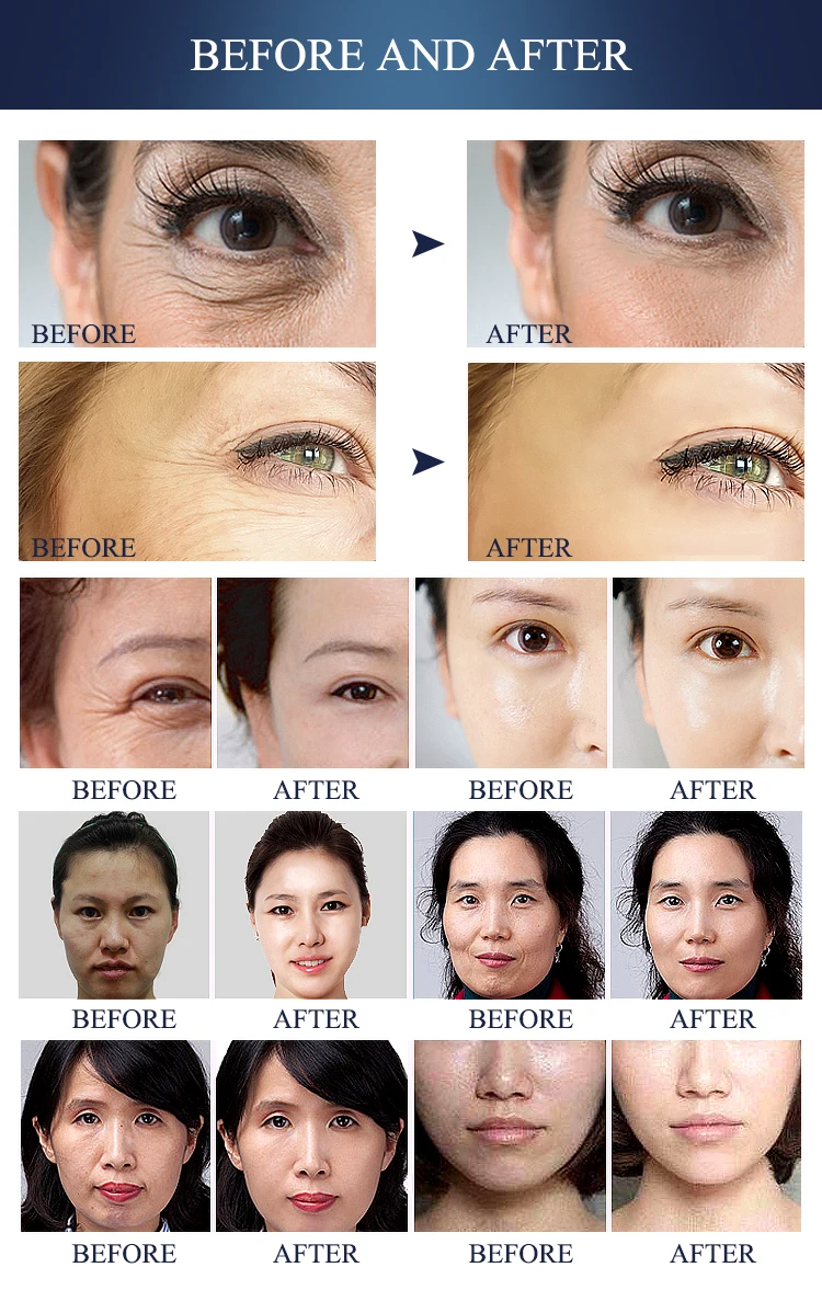 At Home Radiofrequency Skin Tightening Radio Frequency Machine Skin Tightening 0.3mhz 0.5mhz