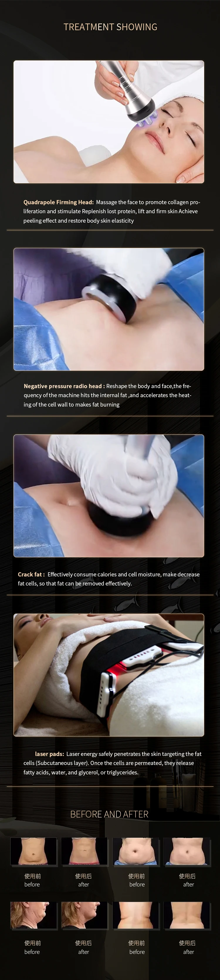 80k Slimming Cellulite Reduction Body Contouring Machine 100k