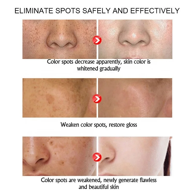 SNMLPM Freckle Removing Cream  30ml Private Label Face Whitening Cream Fade Dark Spot Freckle Face Cream