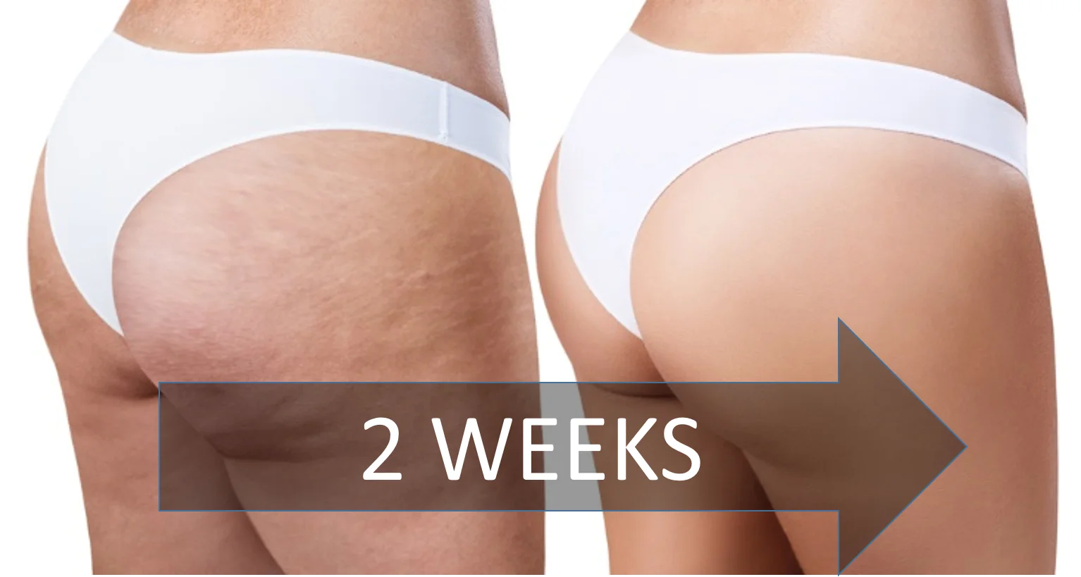 get-rid-cellulite-2-weeks.png