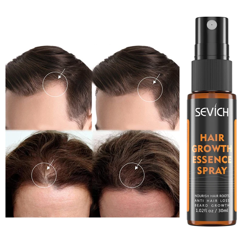 Оптовая продажа с фабрики, питательное средство против выпадения волос, травяное восстанавливающее масло для роста волос, сыворотка-спрей