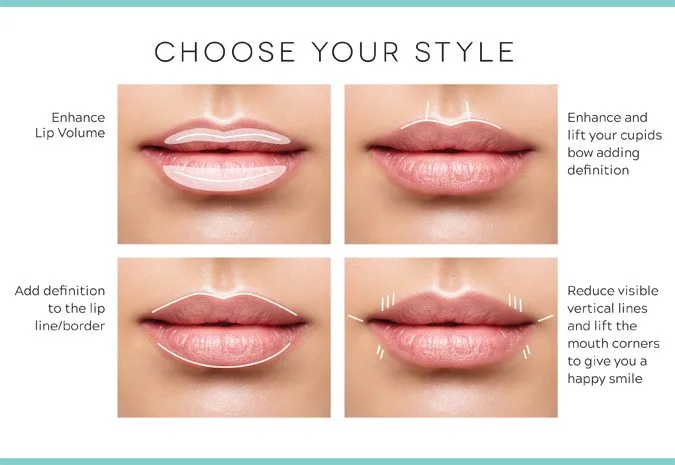 Hot sale acido hialuronico inyectable dermal lip filler injection hyaluronic acid filler for lip injections