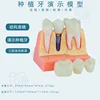 B dental implant yellow bottom blue nail