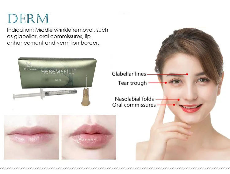 Hot sale acido hialuronico inyectable dermal lip filler injection hyaluronic acid filler for lip injections