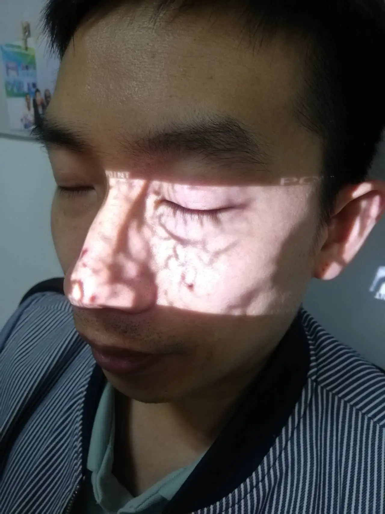 Vein Viewer Portable Sticker to Locate Vein Finder Lamp for Channeling Venous Veins