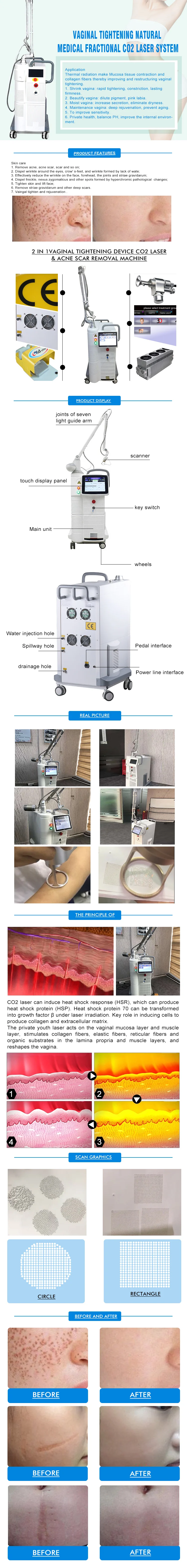 Home Use Co2 Fractional Laser Old Scar Remover Medical Co2 Laser Scar Removal Laser Equipment Co2 Fractional