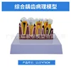 Dental caries model