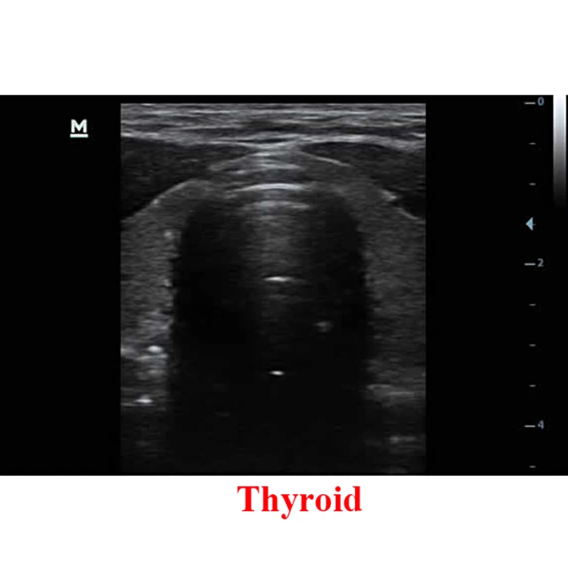 Thyroid.jpg