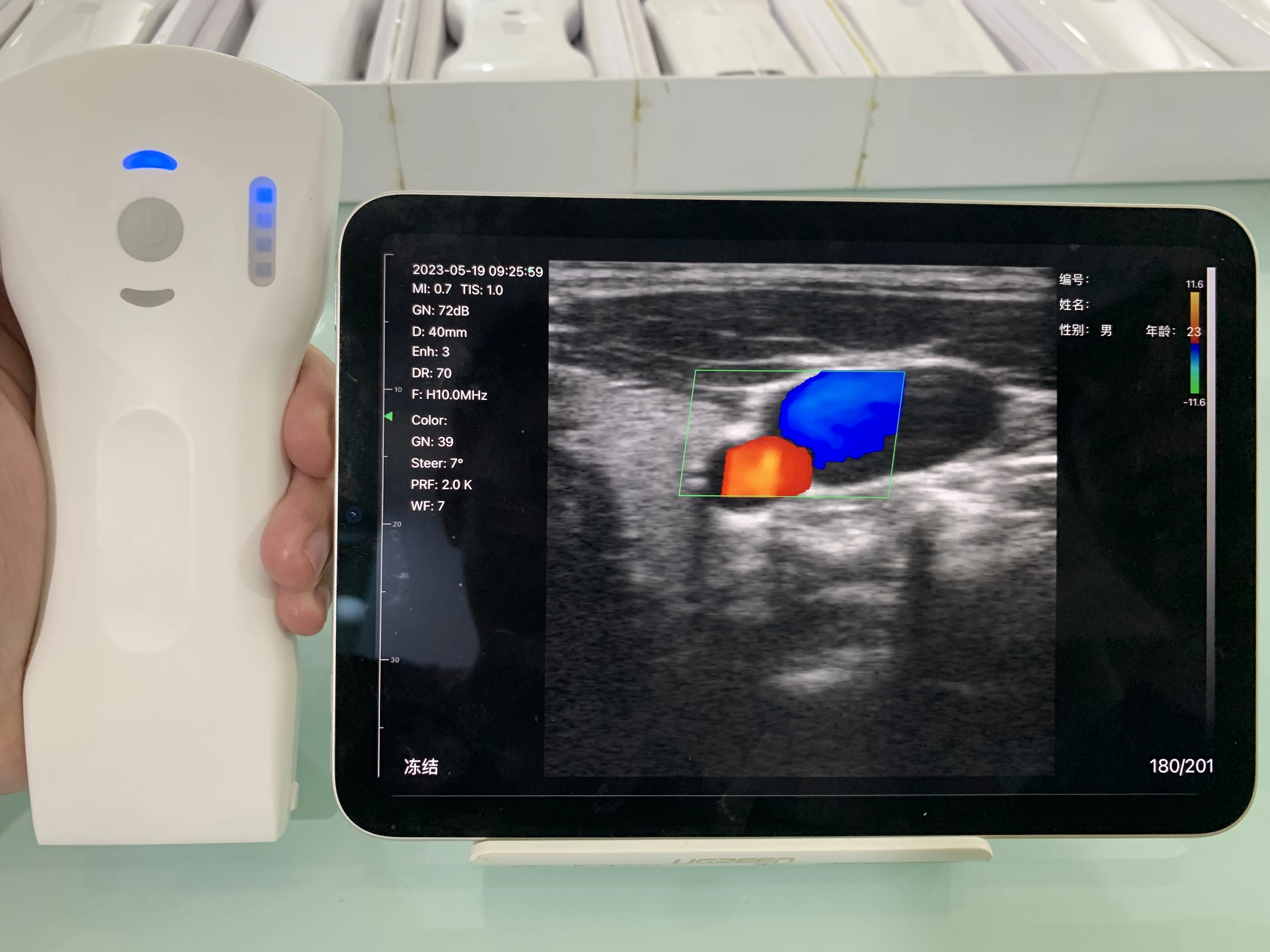 Compact Mobile Ultrasound With Convex Probe Featuring Ultrasound-on ...