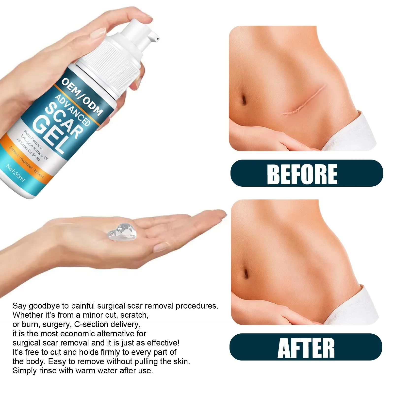 Wholesale Scar Gels for Beauty & Personal Care Lightening Acne Marks Removing Surgical Scars Repairing Scars