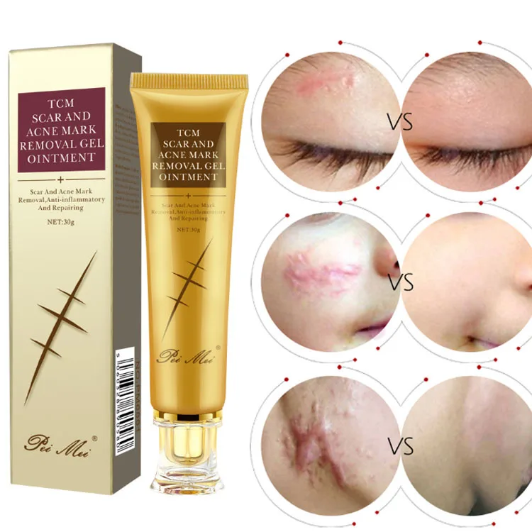 acne scar removal products