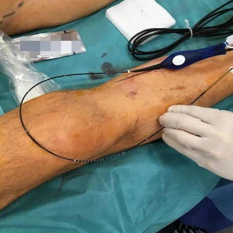 Medical Radial Fiber for Coagulation and Vaporization of Tissue in Endovenous PLDD Laser Surgery for 980 nm and 1470 nm Device