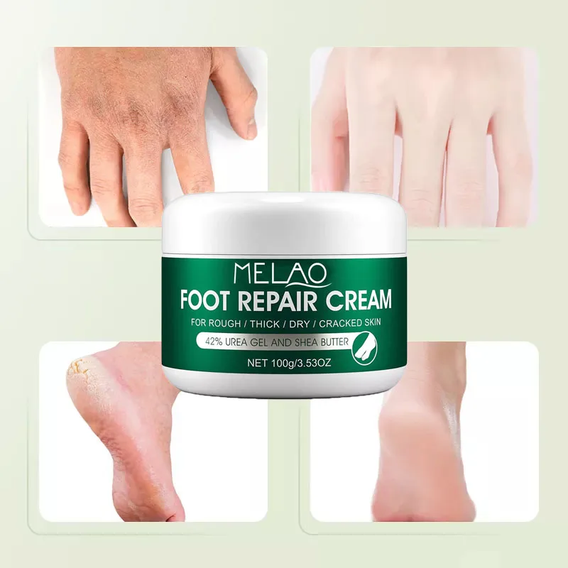Moisturizing Urea Feet Cream Softens Dry, Cracked Skin