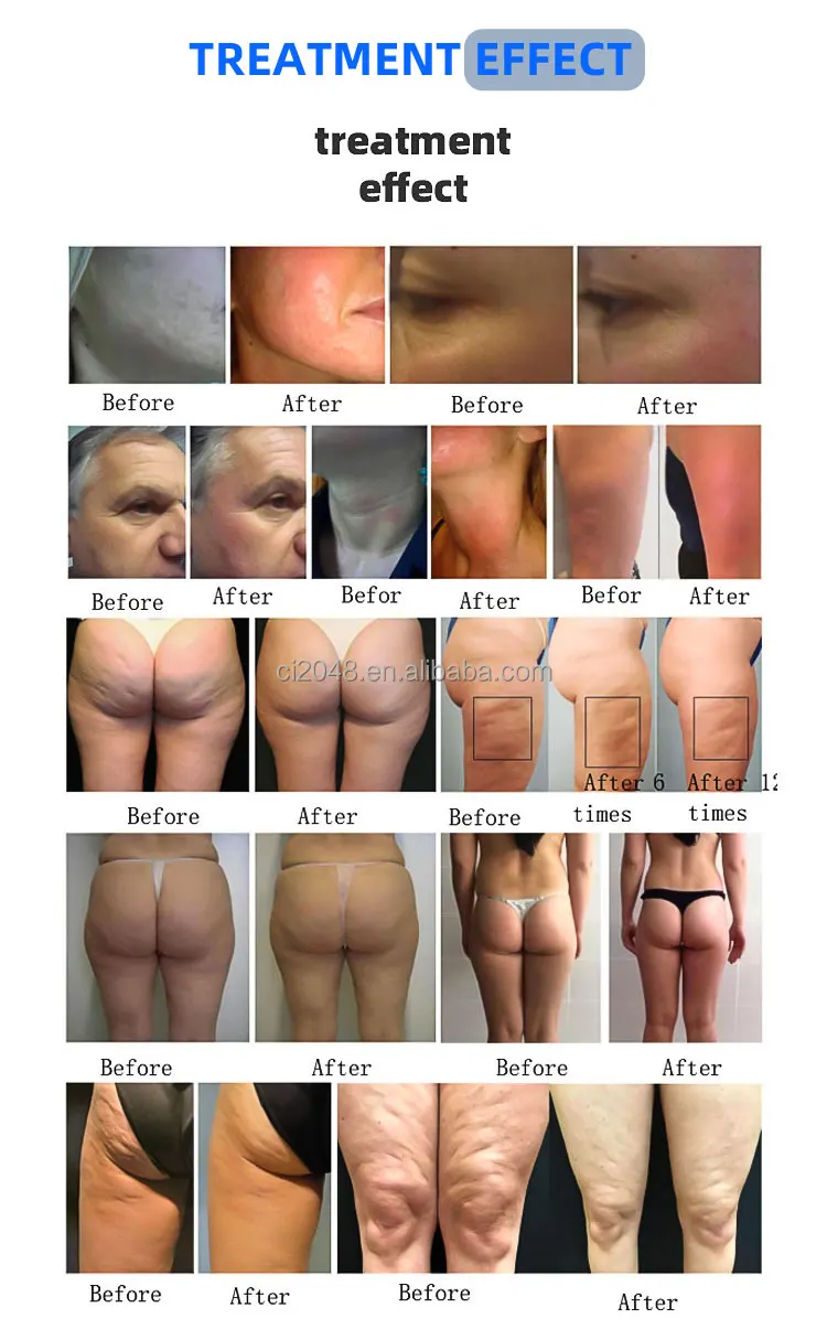 Professional ADG for Endospheres Slimming Massager Machine New Technology Inner Ball Roller for Body & Cellulite Reduction