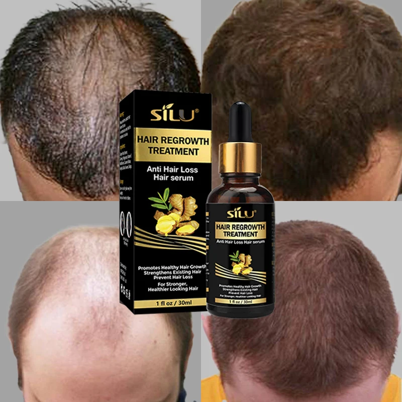 Custom 7 Days Fast Hair Growth Oil Treatment Ginger Hair Regrowth Serum of Hair Loss