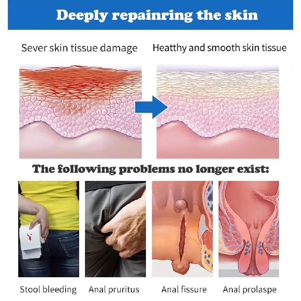 Anti-Itch Cream for Internal External Hemorrhoids Ointment Relieves Pain Itching Burning Swelling Bleeding Healthcare Supply