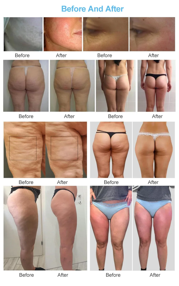 <h3 class="features--headline">Features and benefits</h3> <ul> <li><strong>High-Performance Cellulite Removal</strong>: Effectively smooths out uneven skin and visibly diminishes the appearance of cellulite, leaving clients with a toned and contoured silhouette.</li> <li><strong>Multi-Level Intensity Settings</strong>: Customizable to cater to various skin types and treatment areas, from gentle facial massages to deep-tissue body sculpting.</li> <li><strong>Enhanced Lymphatic Drainage</strong>: Promotes natural detoxification by improving circulation and boosting metabolic activity, reducing fluid retention and bloating.</li> <li><strong>Relaxing, Painless Treatment</strong>: Combines therapeutic massage with cutting-edge technology to deliver a soothing experience that feels indulgent yet transformative.</li> </ul> <hr /> <span class="tw-text-2xl tw-font-bold" style="color: #99ccff;">1 YEAR WARRANTY + 3 YEAR TECH SUPPORT</span> <span class="tw-text-2xl tw-font-bold" style="color: #99ccff;">30 DAY MONEY-BACK AND <a href="https://salonmachines.com/refund_returns/">RETURN POLICY</a></span> <span class="tw-text-2xl tw-font-bold" style="color: #99ccff;">FREE WORLDWIDE SHIPPING <a href="https://salonmachines.com/shipping-policy/">SHIPPING POLICY</a></span> <span class="tw-text-2xl tw-font-bold" style="color: #99ccff;">PROFESSIONAL BEAUTY <a href="https://salonmachines.com/">SALON MACHINES</a> EQUIPMENT</span> Professional Endospheres Cellulite Reduction & Body Contouring Machine