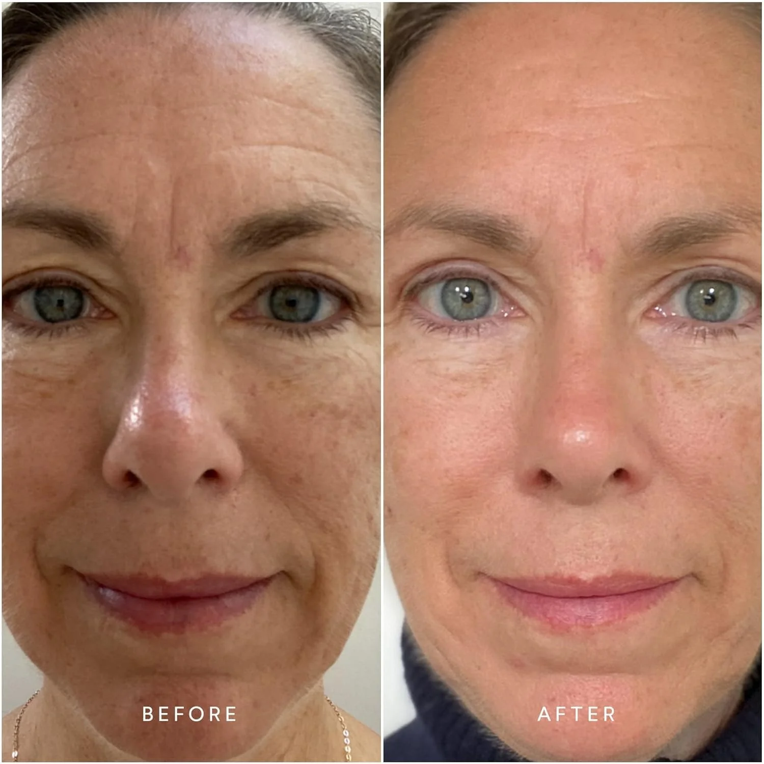 ghk cu peptide before after ✨ Glow from the inside out. GLOW Peptide Therapy is a powerful blend of  BPC-157, TB-400, and GHK-Cu designed to support collagen production, soften  the appearance of fine lines, and improve skin