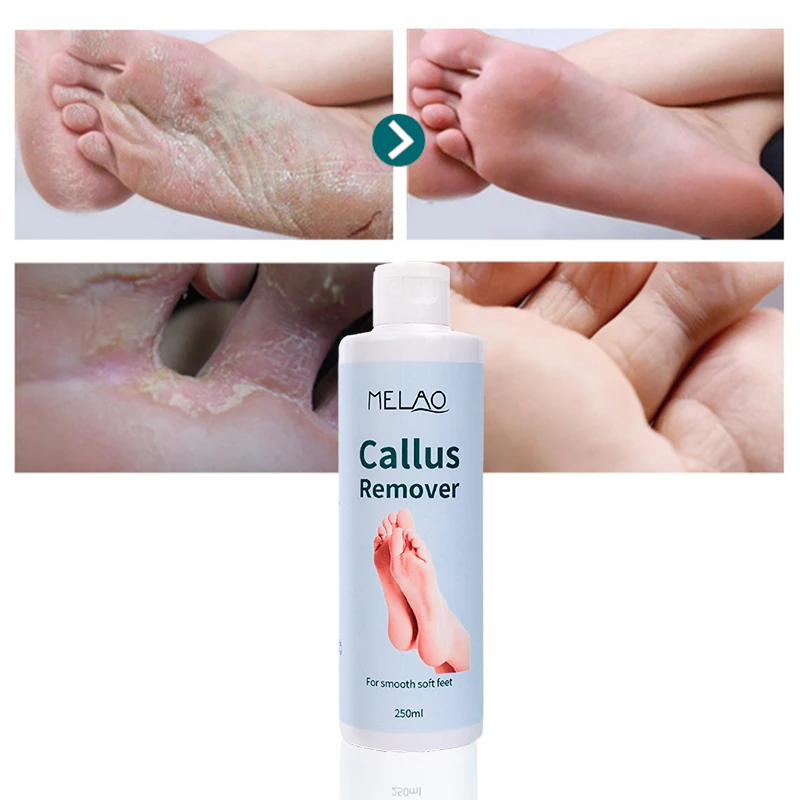 8oz Callus Remover gel for feet for a professional pedicure. Better results  than, foot file, pumice stone, foot scrubber, foot buckets & callus shaver.  Rid ugly callouses from feet in 