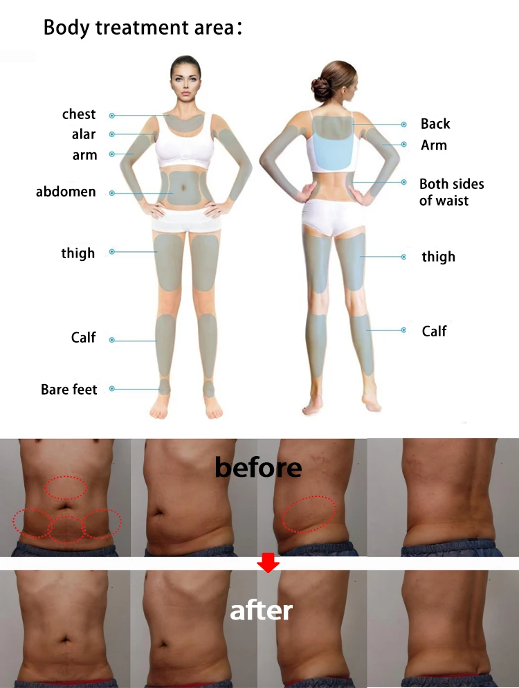 2023 New Model Gold TT 12 D Face Lift Machine 2 in 1 Rotating 360 12D Hifu Mmfu MPTSTL