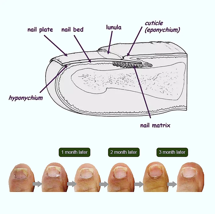 nail fungus laser machine