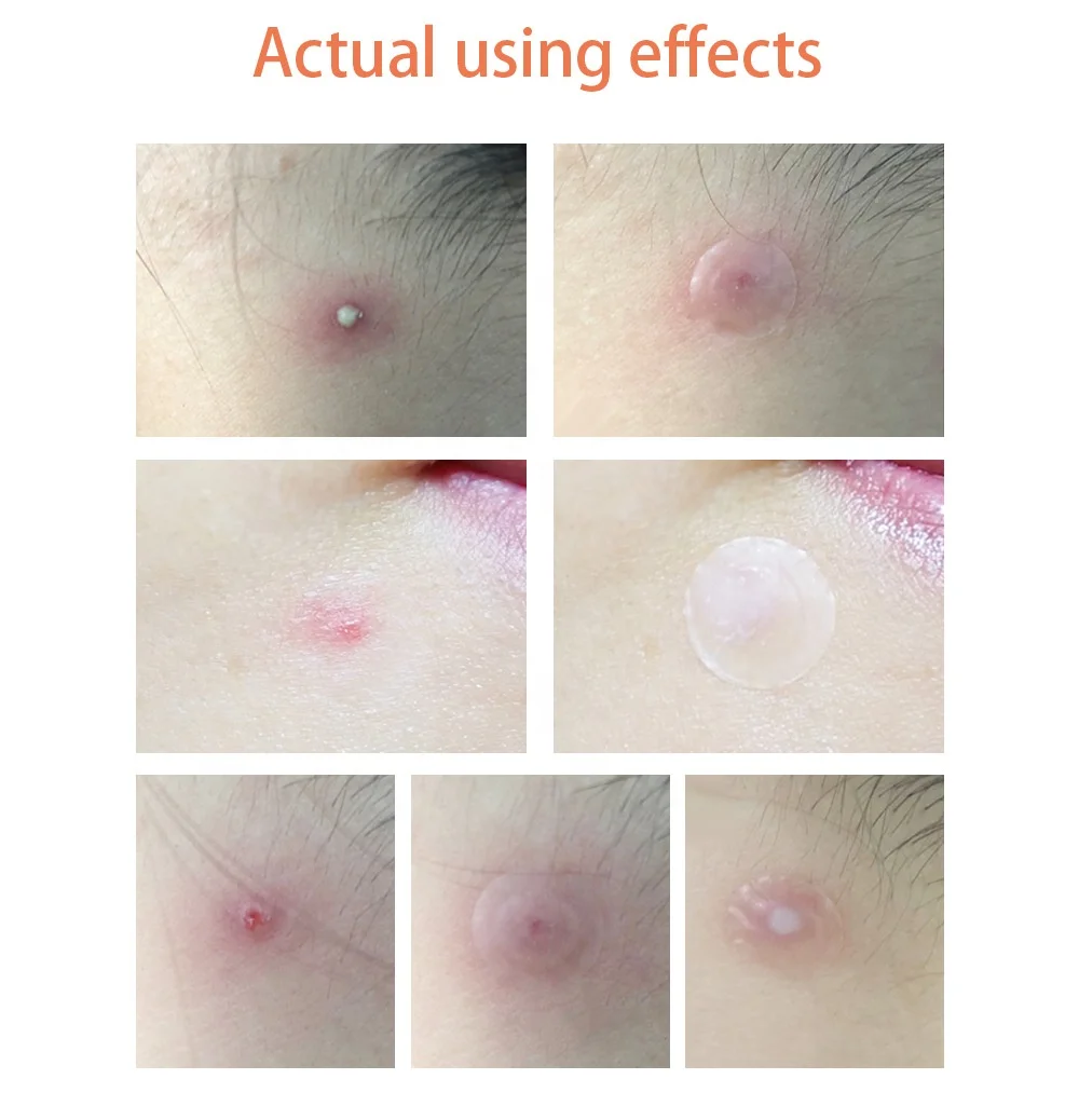 LANBENA Acne Pimple Patch 25pcs Daily Use Invisible Acne Stickers Blemish Treatment Acne Master Beauty Tool Skin Care