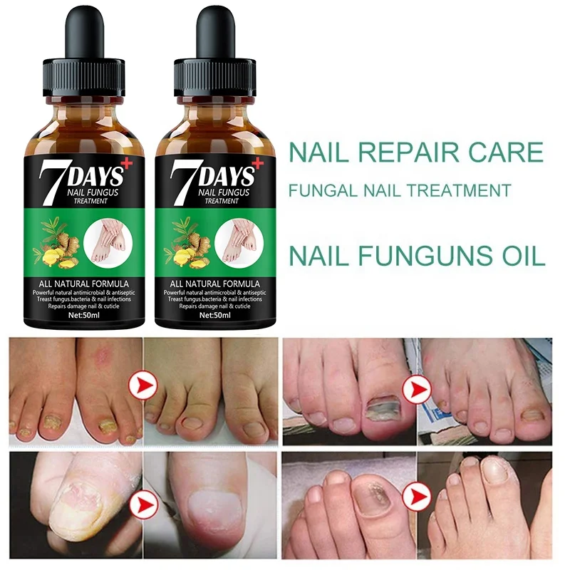 Nail Treatment Essence Serum Care Hand And Foot Care Nail Fungus Treatment  Essence Nails Restore Nail Shine Nail Repair Oil | Fruugo NO