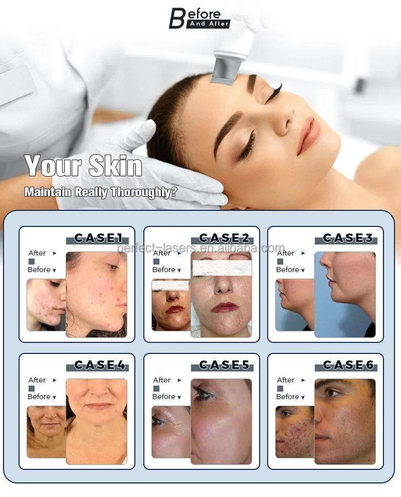 2023 Aqua Hydra Dermabrasion Skin Clean Biopolar Rf Tightening
