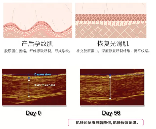 
Частной марки OEM 10 мл 15 мл 30 мл шрамы от акне ремонт глубокий Strech удаление меток сыворотка эссенция для шрамы удалить 