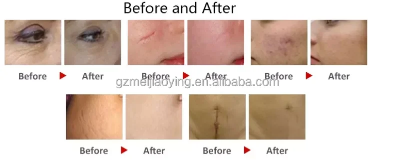 New Professional CO2 Fractional Skin Repair Resurfacing Acne Scars Removal 10600nm 4D Fotona 70W Fractional CO2 Laz er Machine