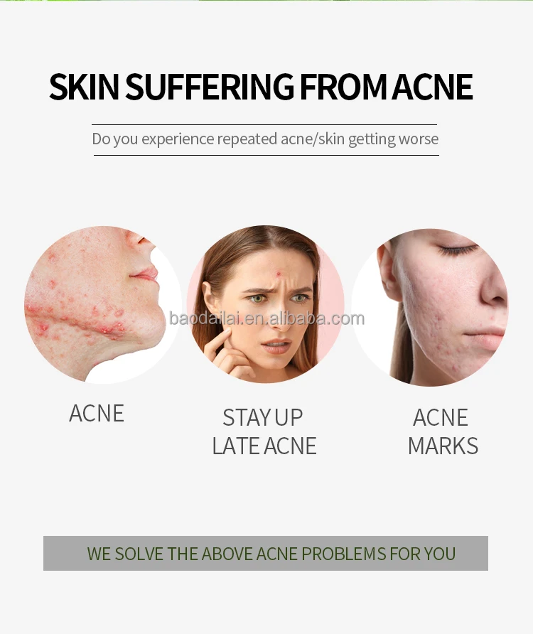 Pretty Cowry Natural Acne Cream Treatment 100 Pure Anti Acne Face Cream