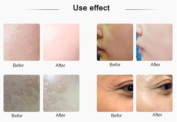 Factory Price Easy To Use Mesotherapy Injection Gun