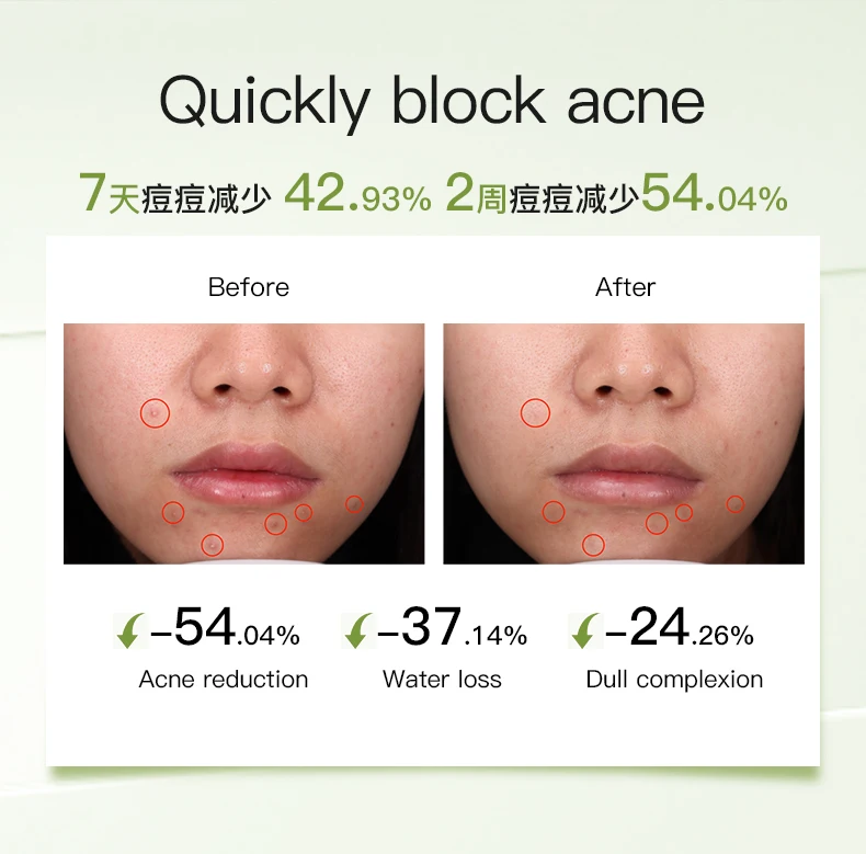 ICESEA Tea Tree Essential Oil Acne Serum Pore Shrinking Facial Oil Control Treatment for Oily Skin Liquid OEM Customizable Logo(pic9)