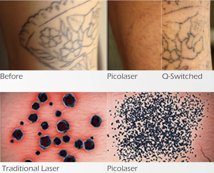 Hot sell Mini eyebrow washing machine nd yag pico laser tattoo removal pico machine