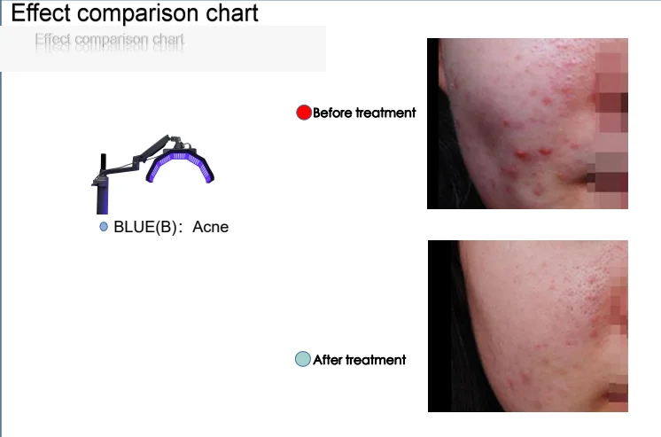PDT LED Light Therapy LED Light Therapy, Photodynamic Red Light Infrared PDT Machine for Acne Skin Rejuvenation