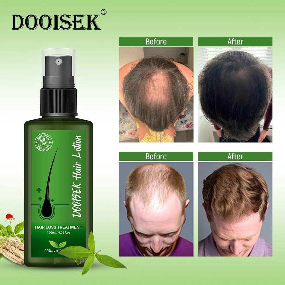 120ml Dooisek Hair Lotion - Regrowth Treatment for Men