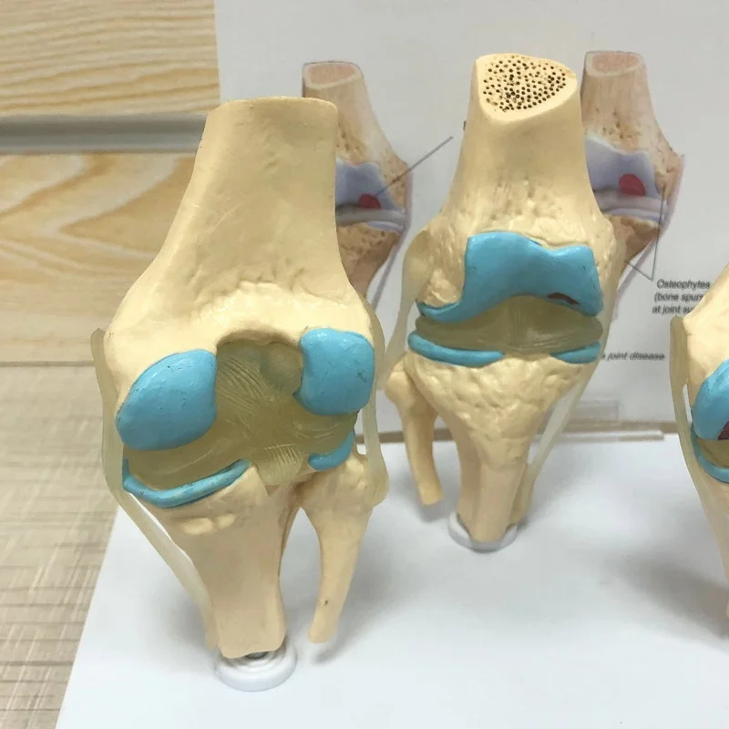 Высококачественная медицинская модель анатомии человека, этапы остеоартрита