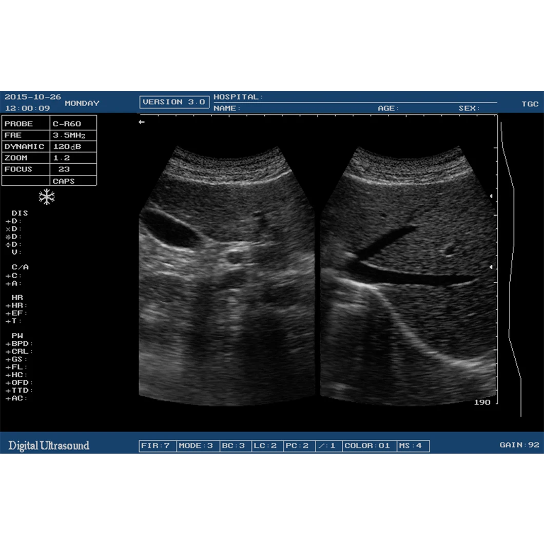 Black and White Ultrasound Diagnosis Equipment Portable Full Digital Altrasound Machine With Printer