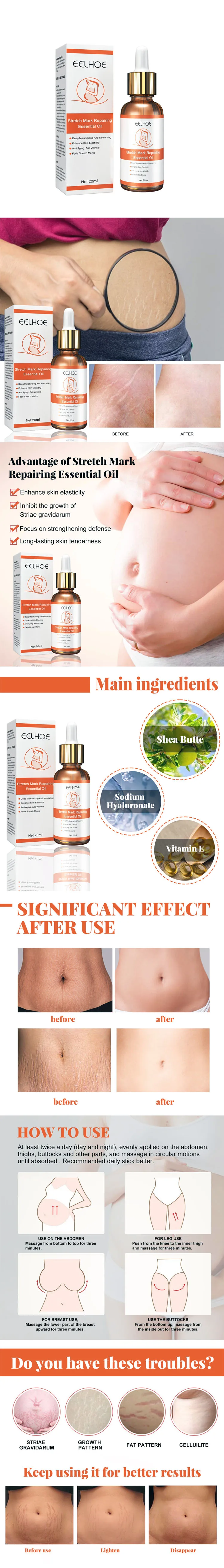 Oem/odm Stretch Marks Remover Essential Oil Skin Care Treatment Cream