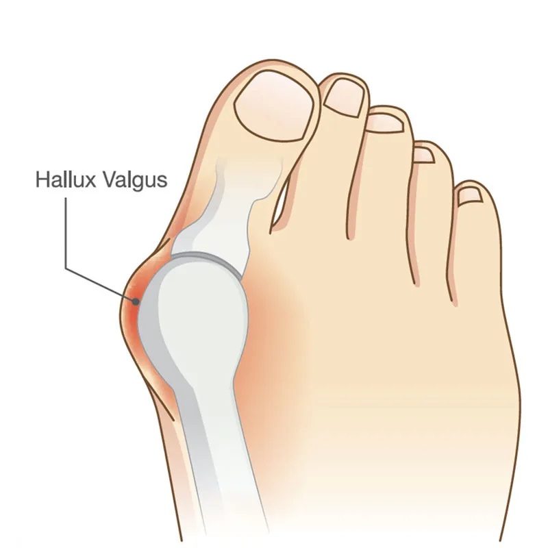 foot feet thumb toe hallux valgus valgus bunion correction corrector separa...