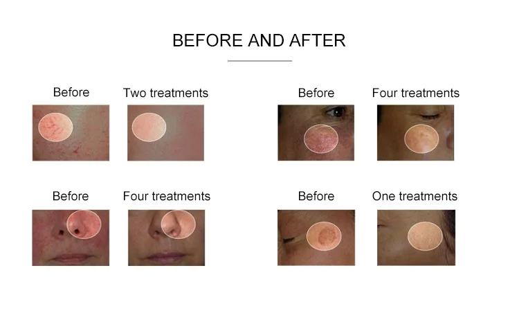 before and after images of using our diode laser spider vein removal machine
