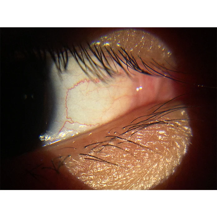 S150D China Ophthalmology 6X Portable Digital ORC Slit Lamp with Mobile Adapter App