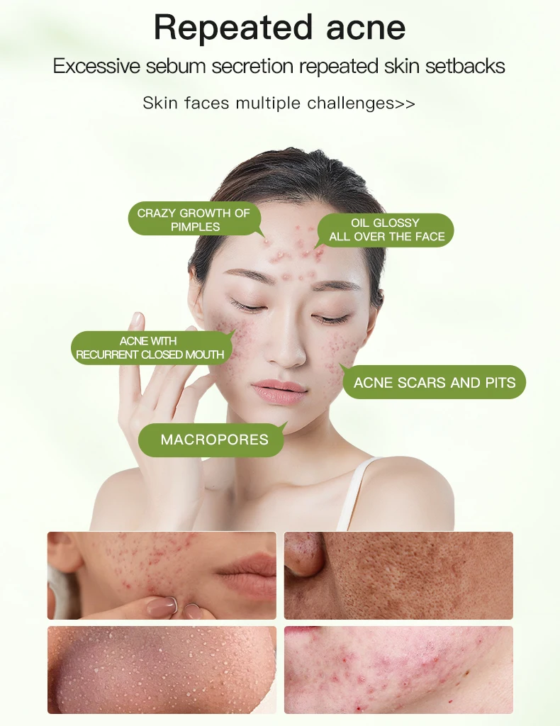 ICESEA Tea Tree Essential Oil Acne Serum Pore Shrinking Facial Oil Control Treatment for Oily Skin Liquid OEM Customizable Logo(pic2)