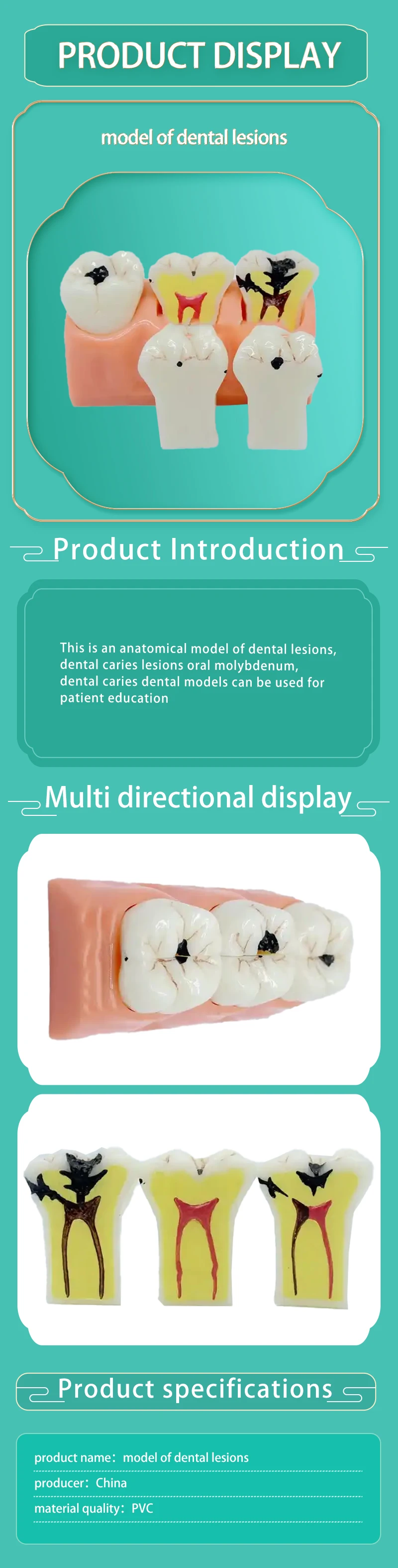 Anatomical Model Of Dental Lesions,Dental Caries Lesions Oral Mo,Dental