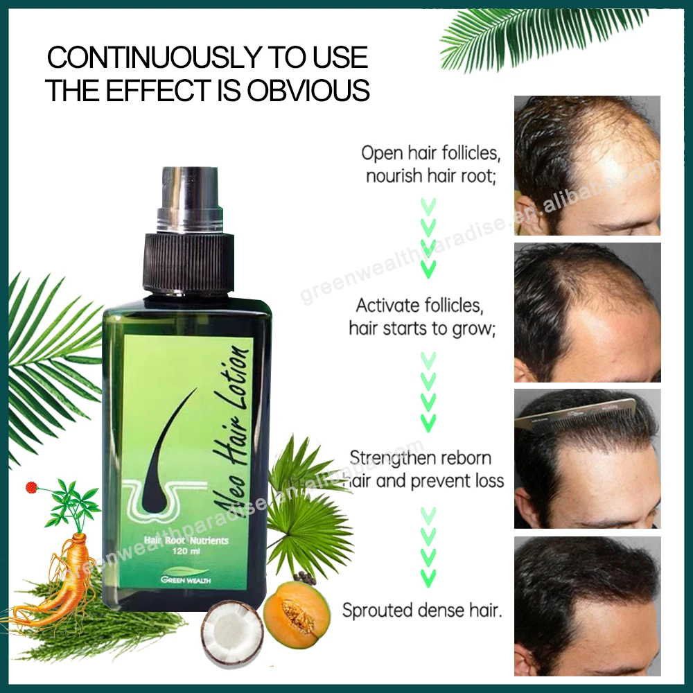 NEO HAIR LOTION  Treatment and Root Nutrients Size India  Ubuy
