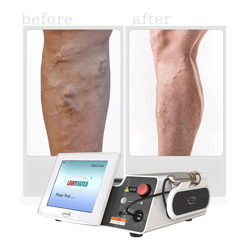 Arañas Vasculares Laser Diodo Vascular 980 Nm Profesional 980nm