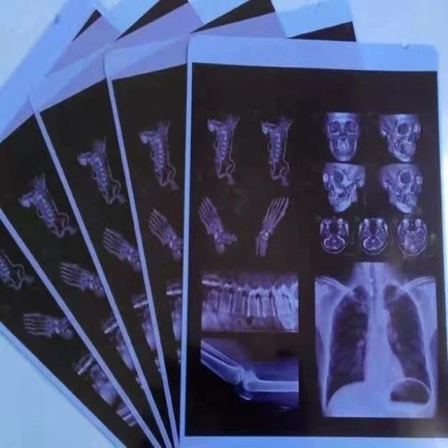 X Ray Digital Inkjet Film  Super Blue  Medical PET Film for Fuji Di Hl  Kodak Agfa Medical X-ray Film for Laser Printers