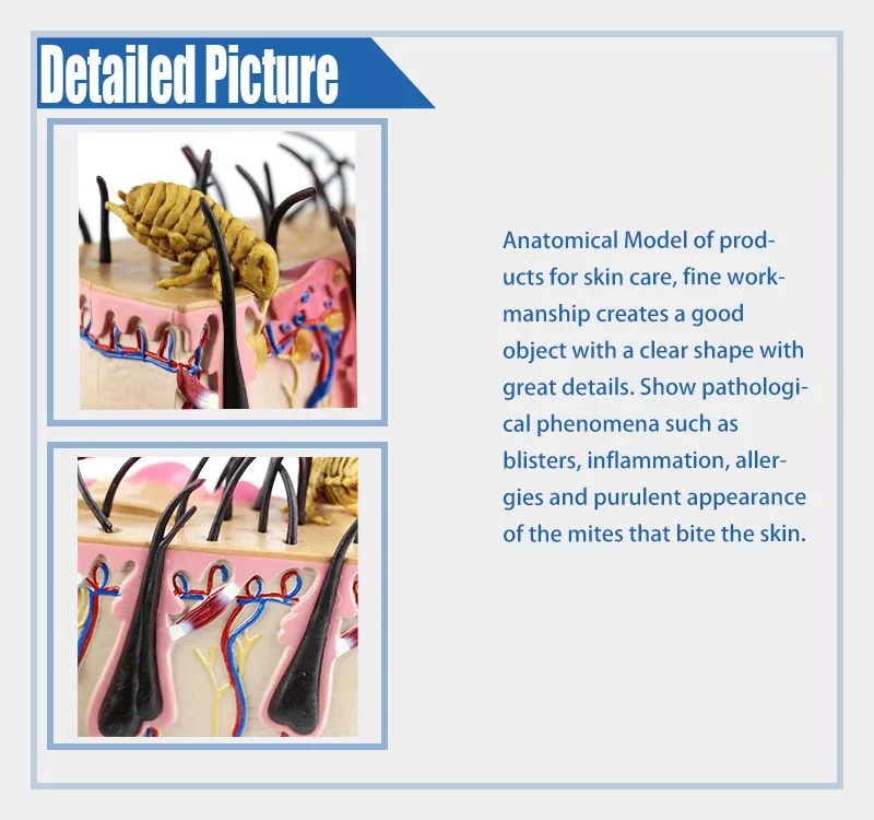 Skin Pustule Model Educational Model Bites Human Skin Anatomical Model Skin Irritation ...