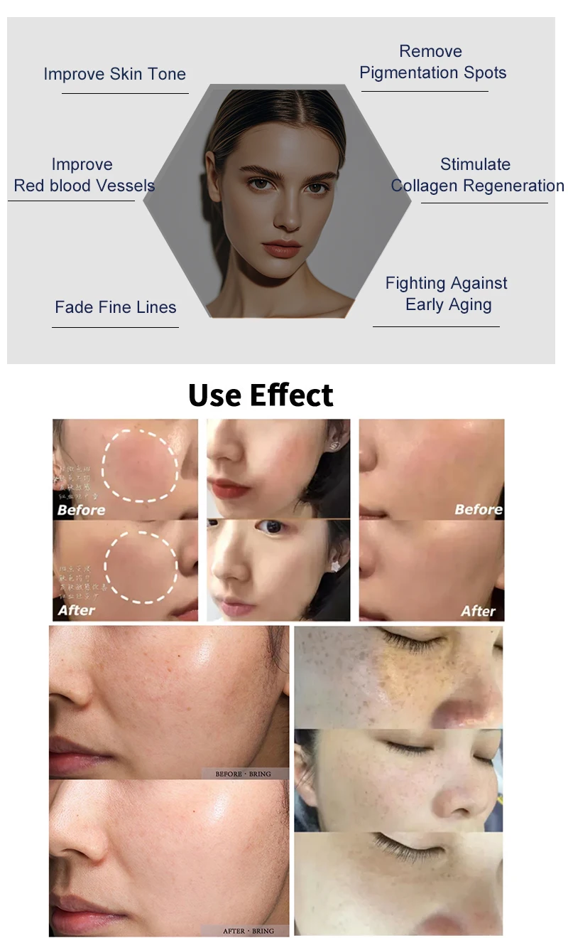 Discover the Black Gold DPL Ultra-Photon Skin Rejuvenation Device, a professional narrow-spectrum light platform designed for pigmentation correction, vascular therapy, acne treatment, and long-term hair reduction for aesthetic clinics and medical spas. Black Gold DPL Ultra-Photon Skin Rejuvenation Hair Removal Device